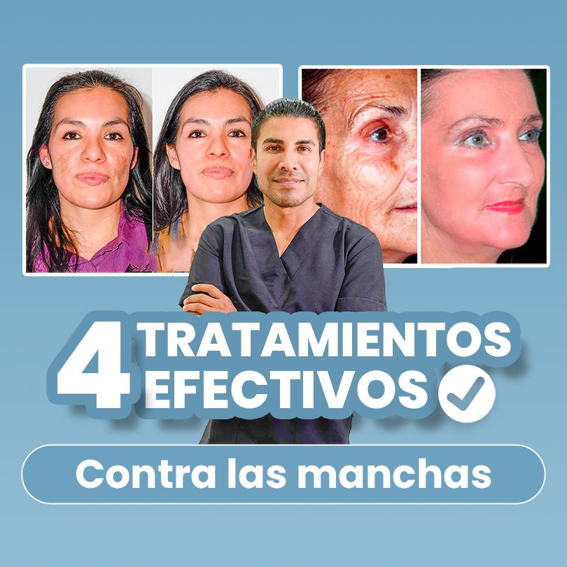 4 tratamientos contra las manchas rostro